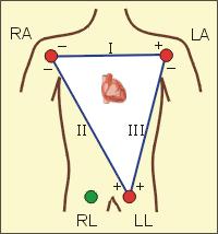 V RA I + V LA + + The three main leads of an electrocardiogram are usually called I, II, and III. These all give different views of the heart dipole.
