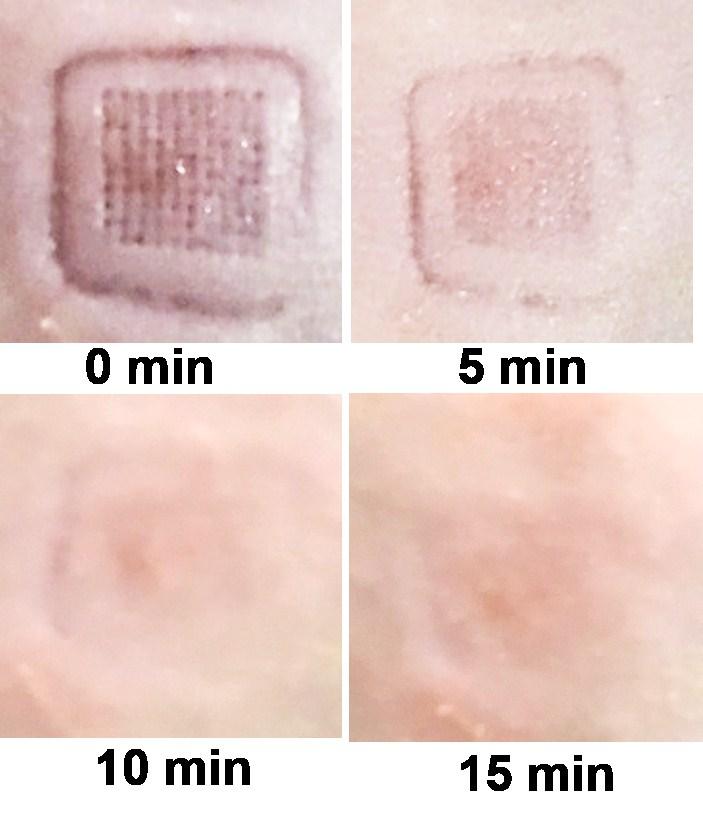 Fig. S5 The recovery of skin after applied microneedles on the living SD rats skin. Table S1.