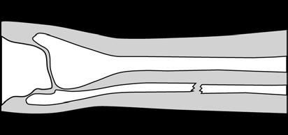 9 4 Both X-ray machines and CT scanners are used to produce images of the body. 4 (a) The diagram shows an X-ray photograph of a broken leg.