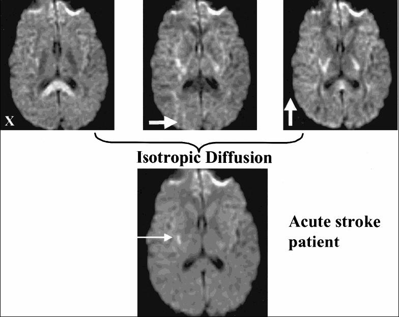 TI in acute stroke (7 hours). Acute ischemic regions appear bright in diffusion-weighted images.
