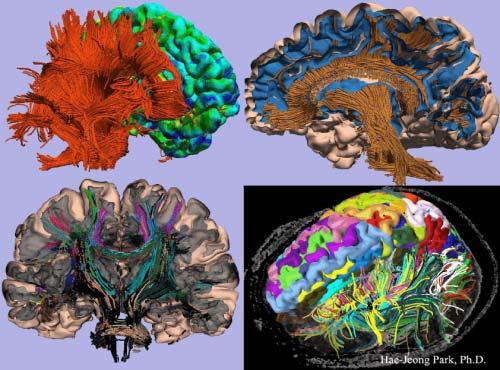 Upper left panel displays fiber tractography combined with cortical thickness map obtained with Free Surfer.