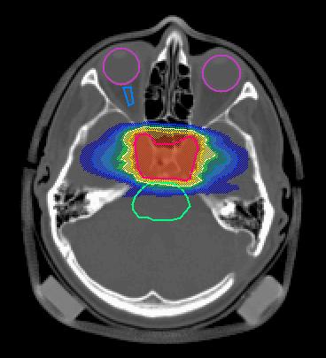 organ at risk (optical nerves) tumour organ at risk (brain stem) Radiation