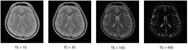 5. [7] Obr. 1.5: Axiálne snímky mozgu s rôznym TR [7] S dlhým TR je veľmi malý rozdiel signálu medzi šedou a bielou hmotou ale s kratším TR sa kontrast zlepšil.