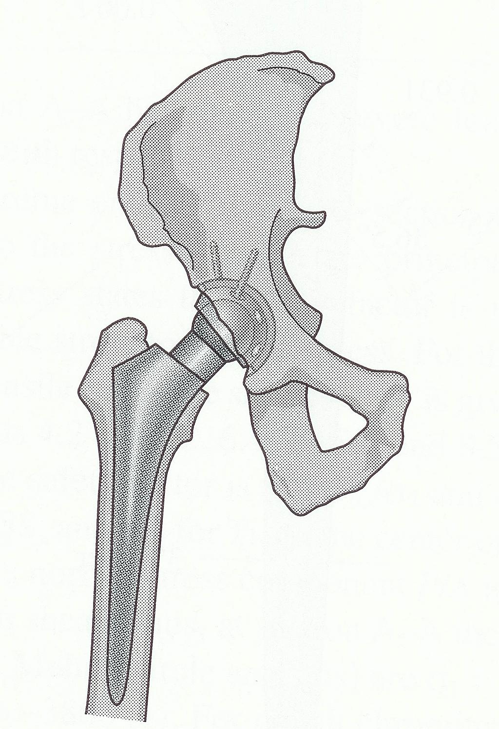 Biomechanics, LTH, 2013 10. The safety factor for a total hip replacement is to be determined. (inches) The problem is to estimate the actual load on the prosthesis.