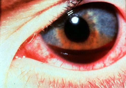 eye released from different sources of bleeding. 2.