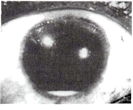 [5-7a & 5-7b]. Particles released from the iris surface again show the same tendency to gravitate inside the eye Fig.