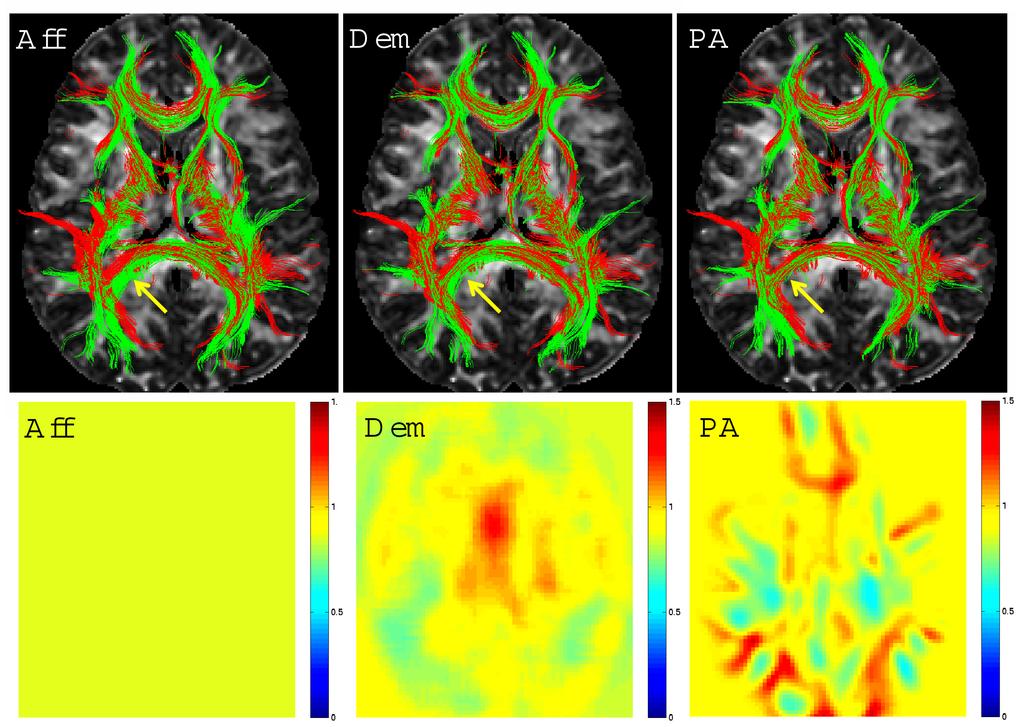 356 3 U. Ziyan et al. Experiments We analyzed 15 full brain Diﬀusion Tensor MR images of resolution 2.5 x 2.5 x 2.5 mm.