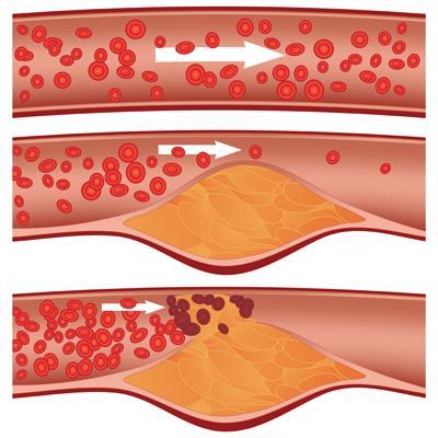Atherosclerosis Atherosclerosis is the hardening of arteries caused by the build-up of fibrous plaque called an atheroma.