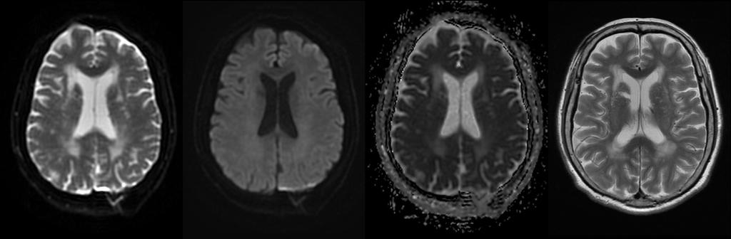 Diffusion-Weighted Imaging (DWI)