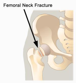 Effect of bone mineral density on fracture risk Bone mineral density measured at the femoral neck (fnbmd) Values: 0.