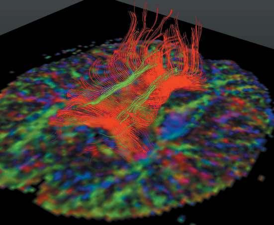 The main eigenvectors of the diffusion tensors determine the local orientation of the fibres. fibres generated by PDD tractography showing part of the cingulum and the corpus callosum.