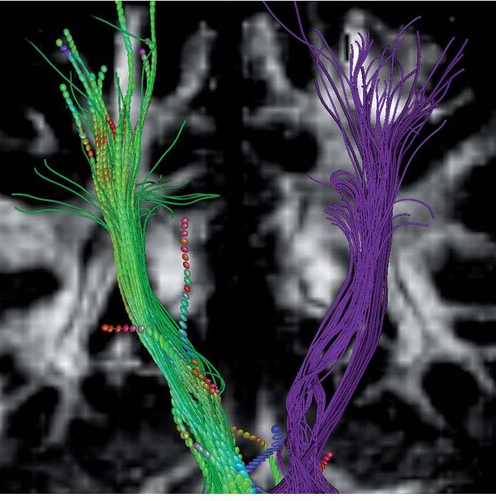 5 Neda Sepasian, Jan ten Thije Boonkkamp, Anna Vilanova Diffusion tensor imaging: brain pathway reconstruction NAW 5/6 nr.