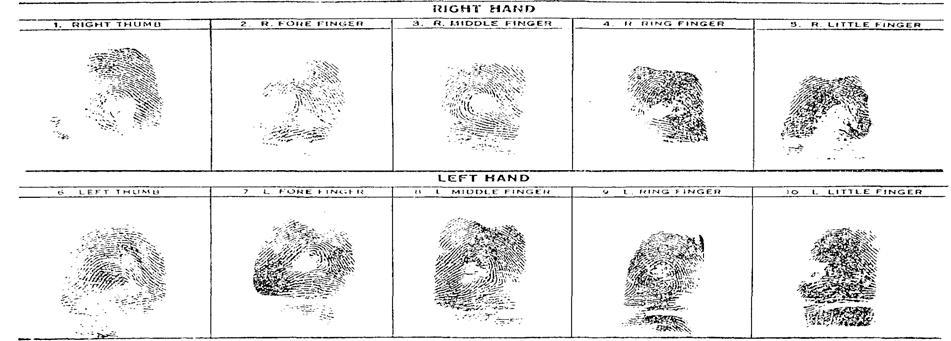 Image showing fingerprint patterns from John Dillinger, after alteration, the