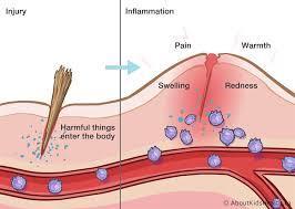 INFLAMMATION Next stage of response is inflammation Skin around the area turns red Your body is sending white blood cells (WBCs) to the area WBCs will eat any