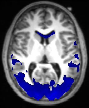 Observing Brain Networks DWI scans: