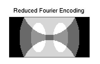 SENSE Imaging An Example Reduced Fourier Speed-Up R=2 Volume Coil Insufficient Data To Determine A & B A+B Reduced Fourier