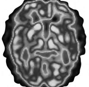 19 (b) Fig. 8.2 shows an image of the brain using a positron emission tomography (PET) scanner. Fig. 8.2 The lighter regions in Fig. 8.2 show the active areas of the brain.