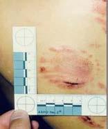 evidence, if enough impression is left behind in skin or