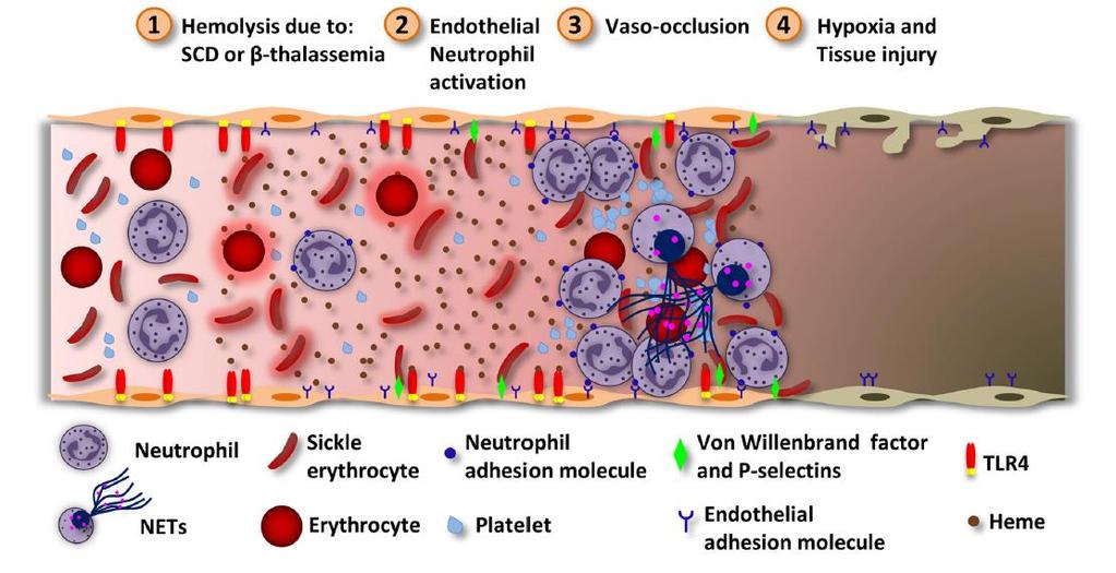 Hemolysis in Sickle Cell Disease (SCD) Hemolysis activates the underlying endothelium: increased expression of endothelial adhesion molecules and apoptotic
