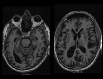 OASIS Data OAS2 0048 66 year old male with dementia (MMSE=19, CDR=1). Five scans collected over 40 months. Marcus, D., A. Fotenos, J. Csernansky, J. Morris, and R.
