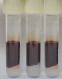 2 1 2 3 Clinical blood samples 16 12 8 4 Sample 1 Sample 2 Sample 3 8 1 12 14 16 18 Fig. S9 The real detection of clinical blood samples with nanotag-(4-t).