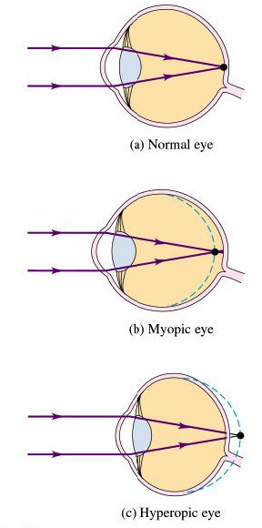 Near point: Far point: The Eye: Optics closest distance at which the eye can focus clearly furthest distance at which the eye can focus clearly Normal eye: near point = 25 cm far point = Common