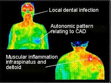 MEDICAL THERMOGRAPHY Measures body tissue heat energy.