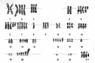 Meiosis 15- Select the statement that correctly explains what could have caused the abnormal karyotype shown above. Note: the organism of this karyotype is 2n. A.