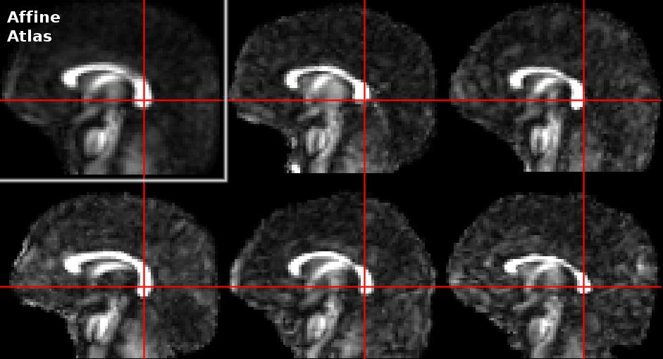 4 Fig. 3. The top six images show the correspondance of the affine atlas and the five subject images at a point in the splenum of the corpus callosum.