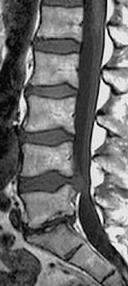 Spine / summar T2 weighted images: TR
