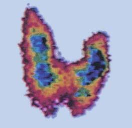 An image of a thyroid gland obtained