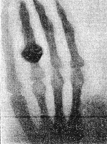 Application of Nuclear Physics First X-ray image by Wilhelm Conrad Roentgen