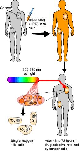 Singlet Oxygen in Photodynamic Therapy 1. Intravenous injection 4. Introduction of laser light 2.