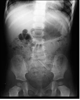 An X-ray photo of a one year old girl who swallowed a sewing pin. Can you find it? Our Sun's radiation peaks in the visual range, but the Sun's corona is much hotter and radiates mostly x-rays.