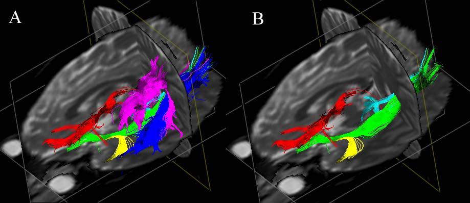 3D views and comparison with anatomical preparation Red: Anterior thalamic