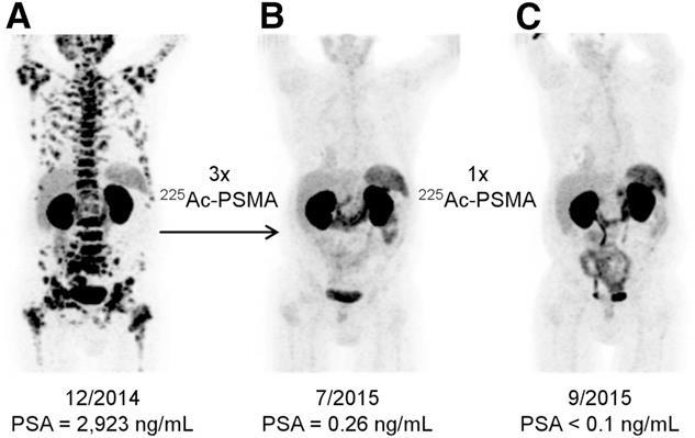 LRP Prostate-specific membrane antigen (PSMA) radioligand therapy 225 Ac-PSMA/ 68 Ga-PSMA: