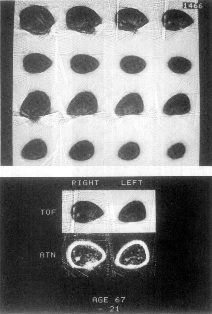 Fig. 4.36: The time of flight (TOF) images on top and the combined TOF and attenuation (A TN) images on the bottom show the small cancer. (Reprinted with permission from [Sch84J.