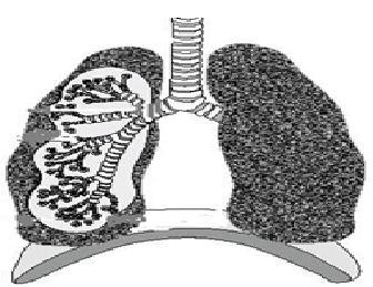 3 6. Diagram 6. shows the lungs of a smoker. Rajah 6. menunjukkan peparu seorang perokok. Diagram 6. Rajah 6. ( i ) Why the lungs of the smoker became black? Mengapakah peparu perokok menjadi hitam?