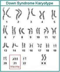 24. The following karyotype shows the chromosomes for a person with Down Syndrome. What happened during cell division that would cause this to occur? 25.