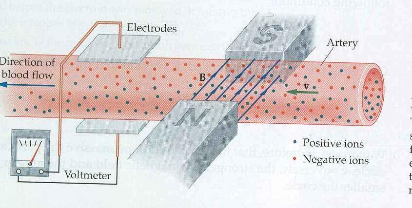 Electromagnetic Flowmeter E Moving ions in the blood are deflected by magnetic force Positive ions deflected down, negative ions deflected up This separation of charge