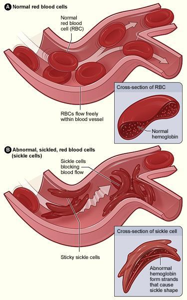 Natural Selection & SCA Sickle Cell Anemia (SCA) is a genetic disease affecting the shape of RBCs, creating symptoms of fatigue, body pain, organ