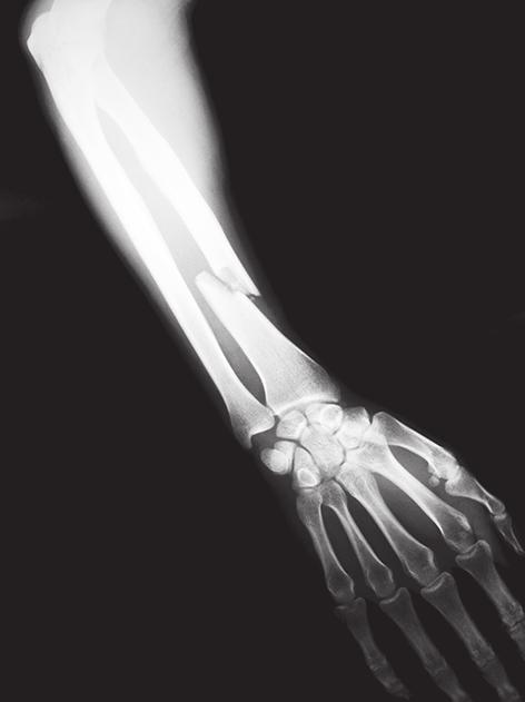 10 3 (d) Figure 5 shows an X-ray of an arm with a broken bone. Figure 5 3 (d) (i) Describe how X-rays are able to produce an image of bones.