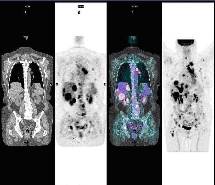 Diagnosis Isotopes allow us to see where cancer has spread in the body PET (Positron Emission Tomography) is an important