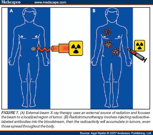 Therapy cancer can be treated with external radiation or via direct application of isotopes The use of isotopes in therapy