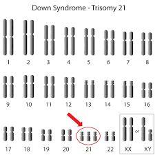 An example of this is down syndrome which is when there is a trisomy or extra chromosome where the body has three copies of genes instead of two.