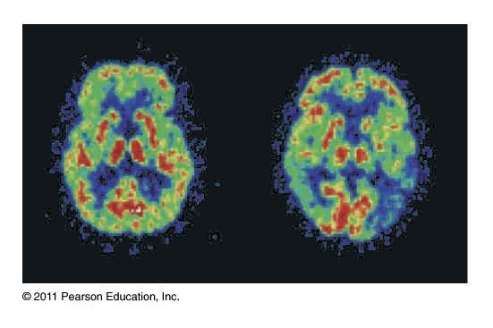Positron Emission Tomography (PET) These PET scans of the brain show a normal