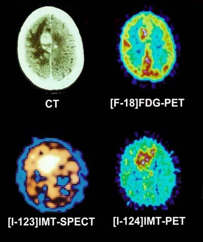 Multimode Imaging Brain Tumour Mapping Langen et al.