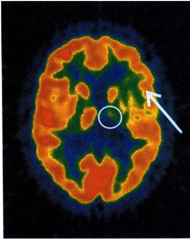 PET Imaging of Brain of a Stroke Patient administered with 18 FDG Decreased uptake of 18 FDG in infarct region (circle) as well as in the brain skin (arrow) An important information for the