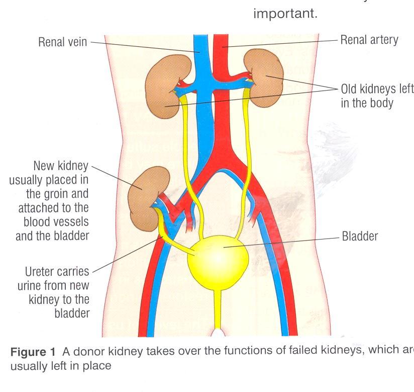 KENDRIYA VIDYALAYA SANGATHAN, CHENNAI REGION SUMMER HOLIDAY HOMEWORK 2018-19 CLASS: X SUB: SCIENCE Kidney Transplantation A person with kidney failure may have a kidney transplant.