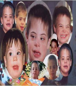 DOWN SYNDROME TRISOMY 21 Children with Down Syndrome have a variety of problems, including mild